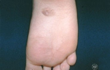 congenital mole on foot