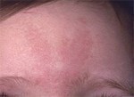 Picture of Salmon Patches - WebMD
