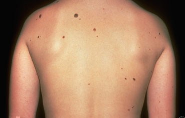 Atypical moles on back