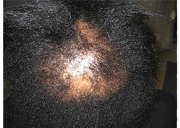 Dermatologist Hair Loss on Hair Loss  She Should See A Dermatologist  The Earlier Treatment