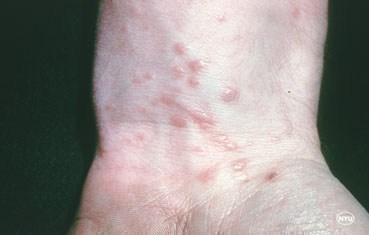 Topical steroid for shingles