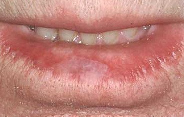 White Patch On Inner Lower Lip