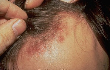 Seborrheic Dermatitis Causes, Treatment & Pictures