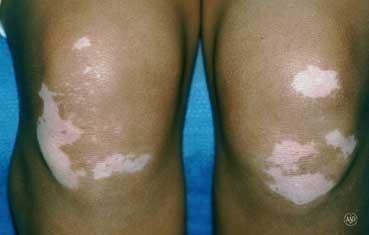 vitiligo on knees