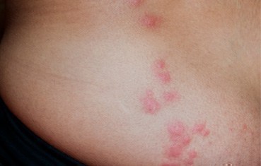 Bedbug bites : Most people who are bitten by bedbugs have welts that ...