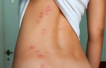 Bedbug bites : The bites often appear in a zigzag pattern as shown ...