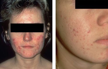 women with acne
