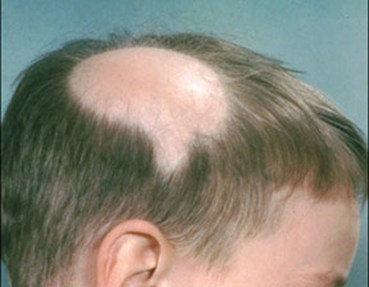Alopecia areata - bernhoven.nl