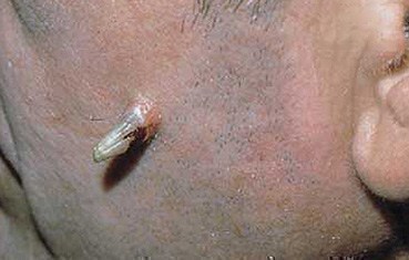 Keratosis Pilaris Itchy | Water's Edge Dermatology