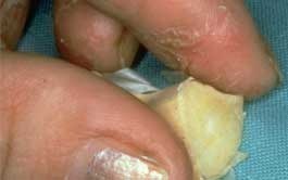 nummular dermatitis treatments #11