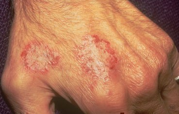 Cystic lesions on the hands - The Clinical Advisor