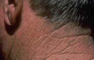 itchy scalp rash on neck - MedHelp