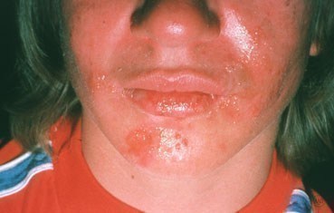can you get cold sores on your chin #11