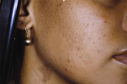 Image result for acne black skin