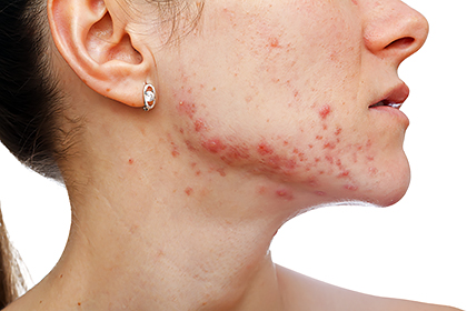acne-severe-treatment.jpg