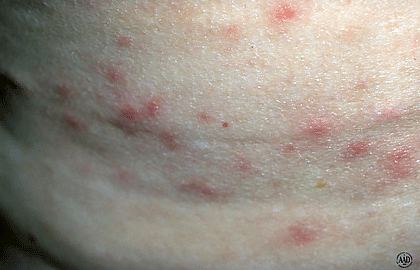 Acne Like Breakouts Could Be Folliculitis American Academy