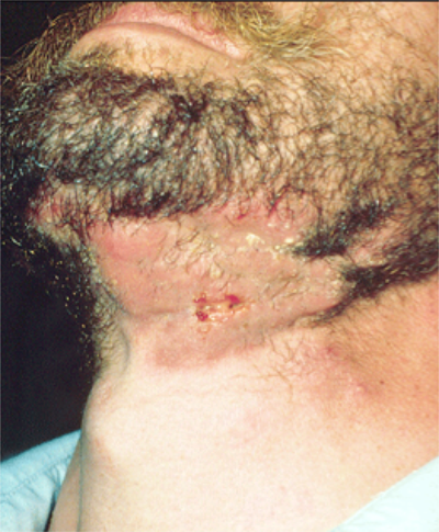 Ringworm of the Scalp or Beard | Health Encyclopedia ...