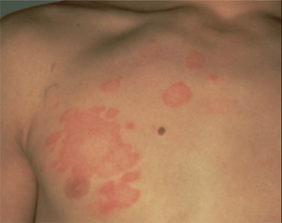 Ringworm and other fungal infections - NHS Choices