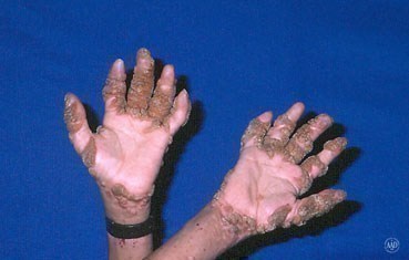 warts-symptoms-hands-.jpg