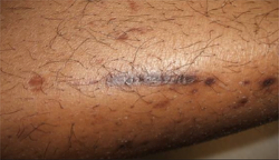 # Diabetic Skin Conditions Pictures - Prevention Of Type 2 ...