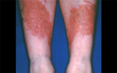 Hiker’s rash: red rash between knee and ankle after hiking ...