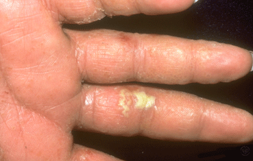 Dyshidrotic Dermatitis - Dermatitis Information