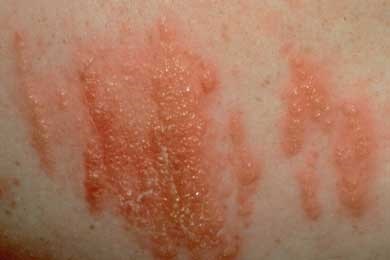 Image result for poison oak rash