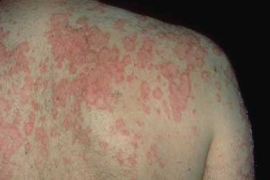 Resultado de imagen de rashes lupus after sun