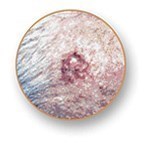 types-of-skin-cancer-basal-cell-carcinoma.jpg