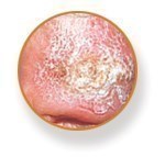 types-of-skin-cancer-squamous-cell-carcinoma.jpg