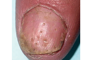 fingernail-with-pitting.jpg