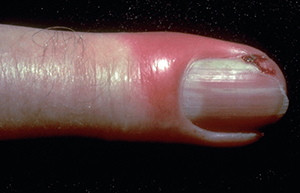 infection-around-fingernail.jpg