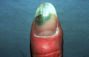 infection-under-fingernail.jpg