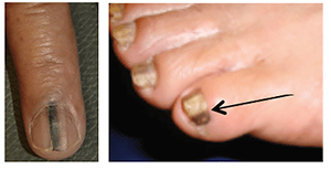 melanoma-under-nails.jpg